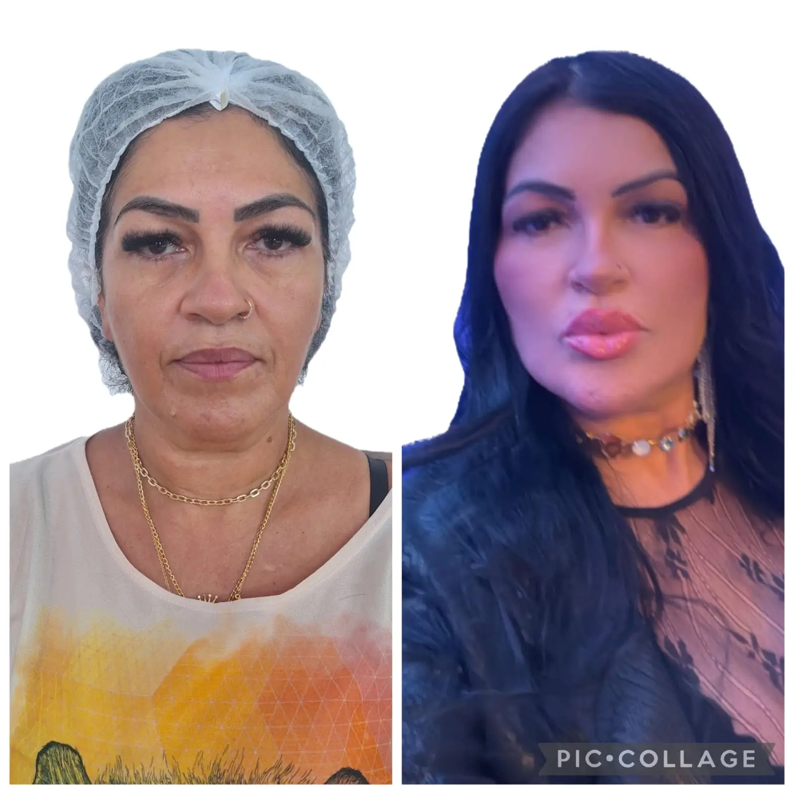 Harmonização Facial completa