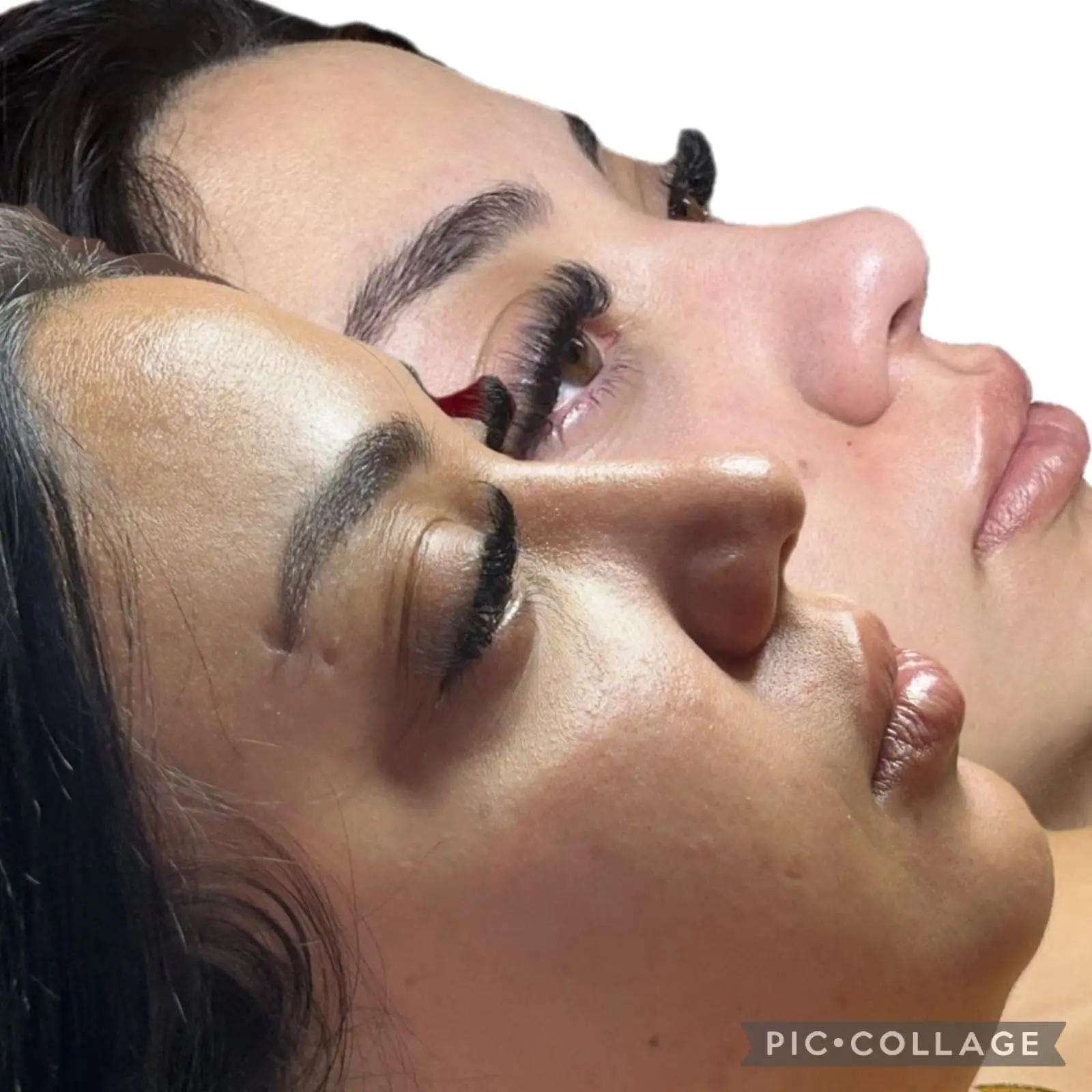 Resultado de Rinomodelação sem cirurgia