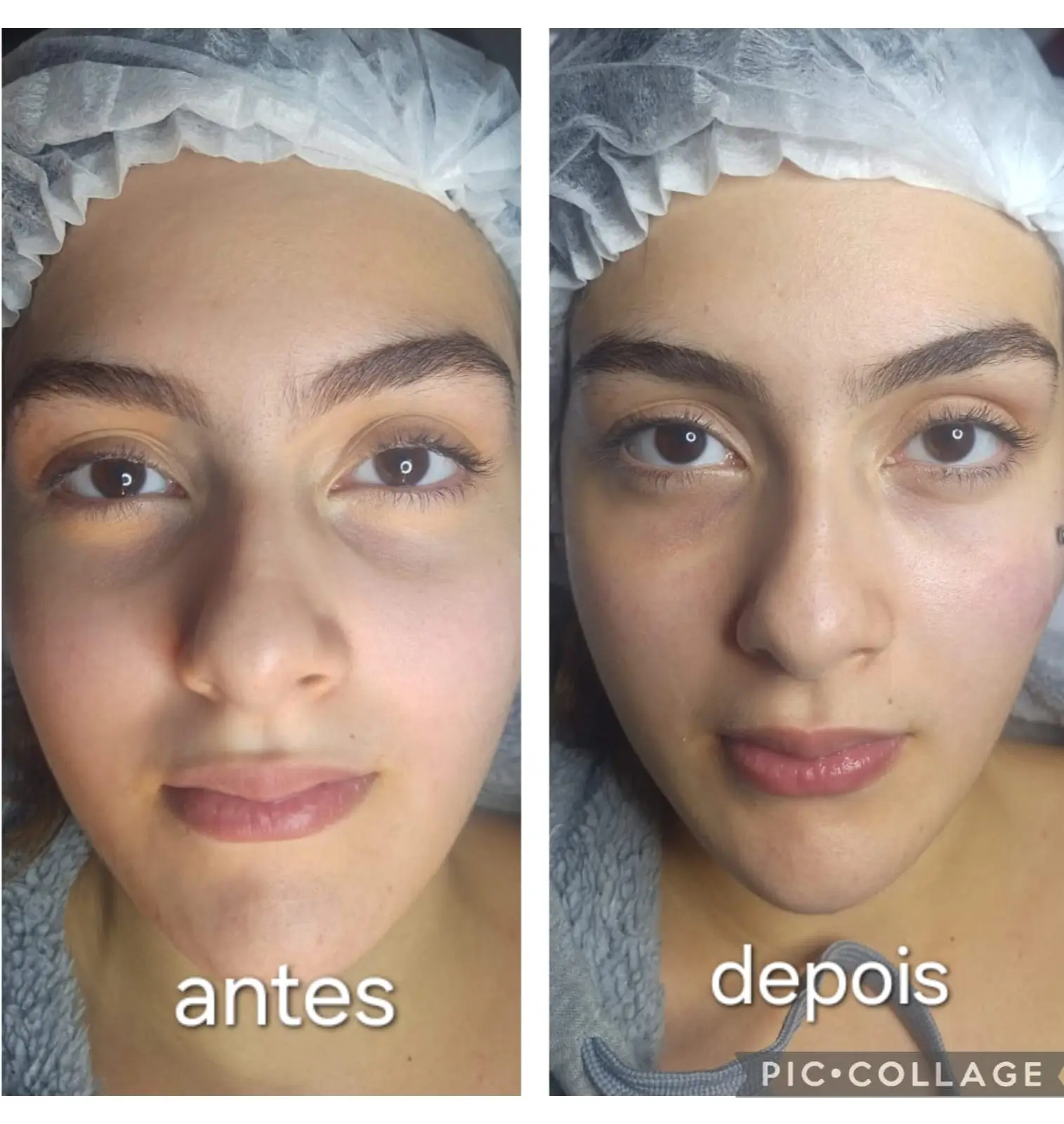 Tratamento para Preenchimento de Olheiras